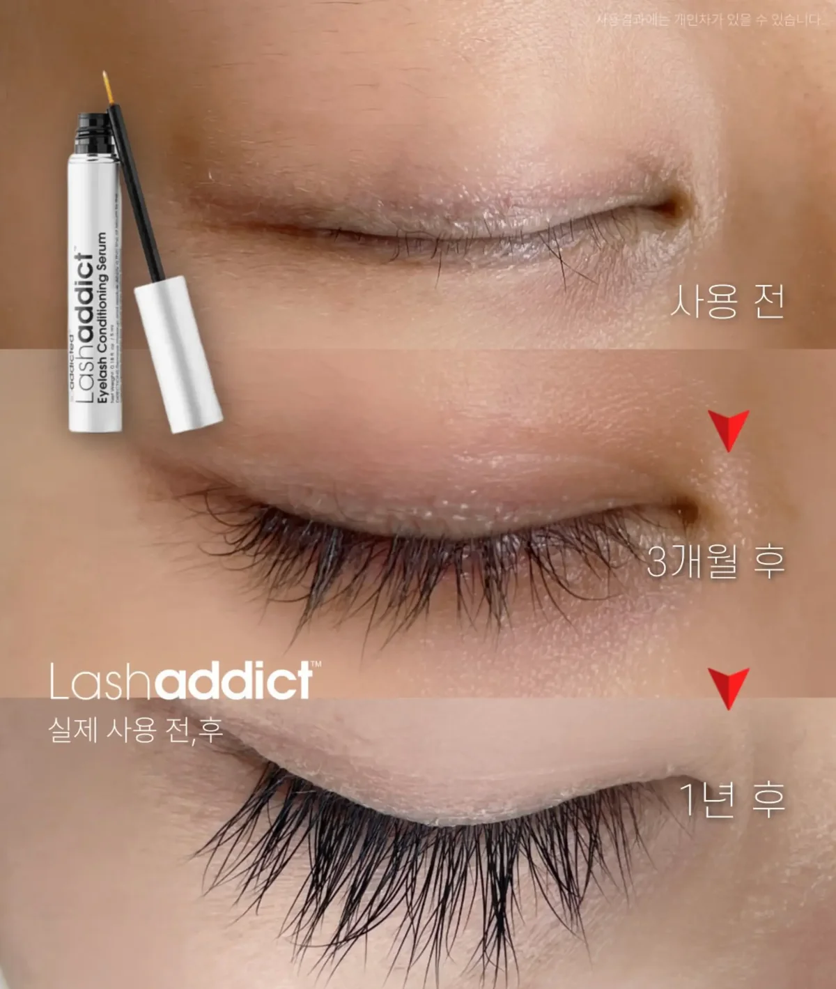 래쉬애딕트 사용 전, 3개월 후, 1년 후 경과 비교